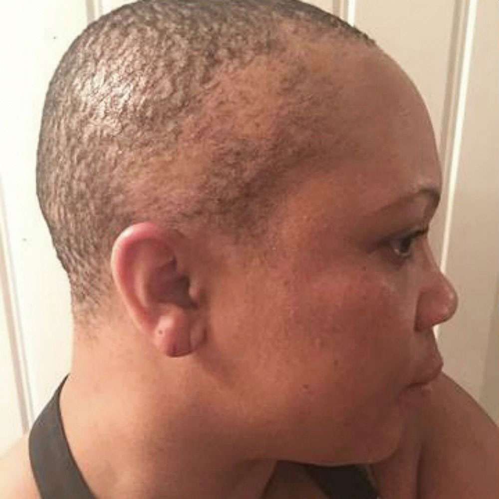 Alopecia treatment in florida