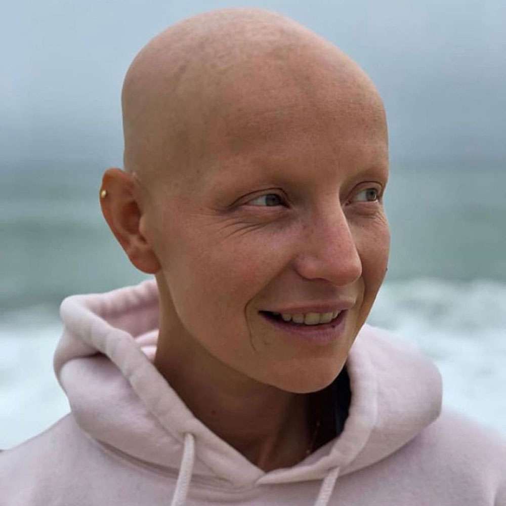Alex Corona Alopecia Treatment